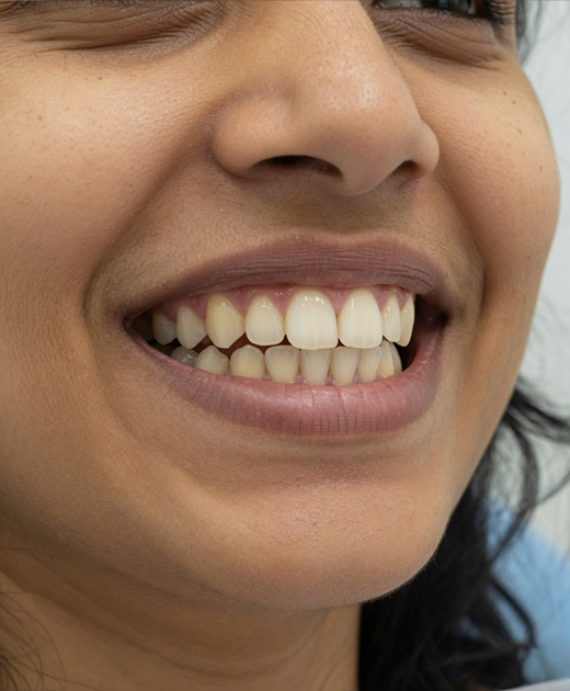 Gapped Teeth After