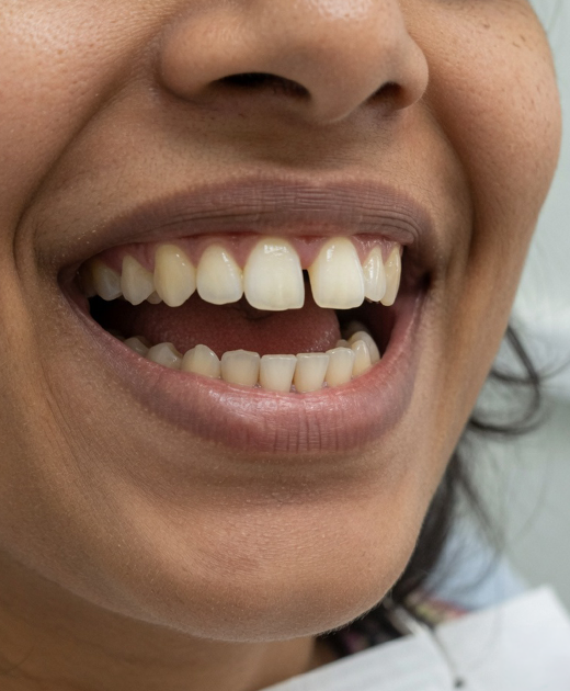 Gapped Teeth Before