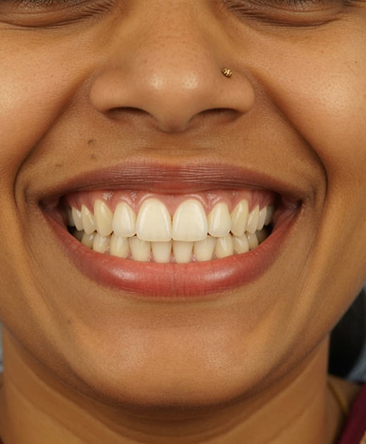 Under Bite After