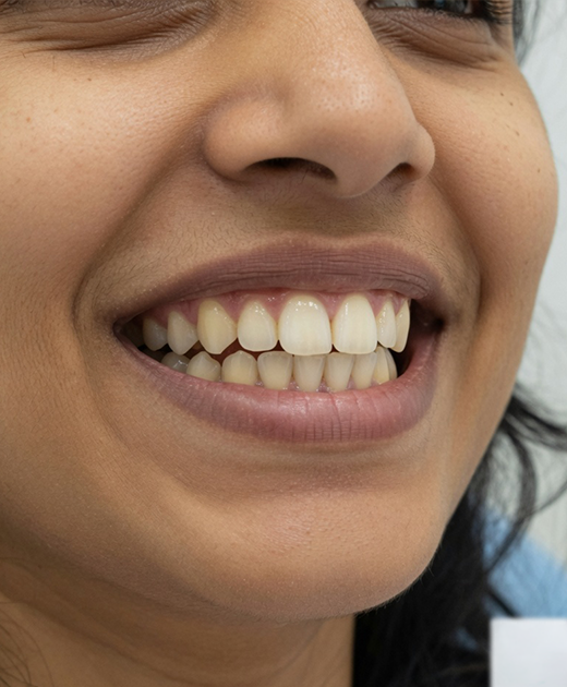 Under Bite Before